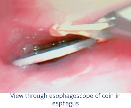 esophagoscopy-2