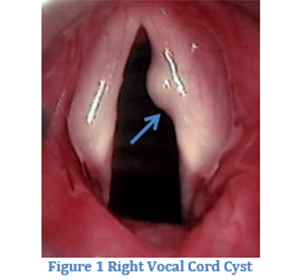 vocal-cord1