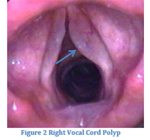 vocal-cord2