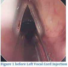 vocal-cord-injection1