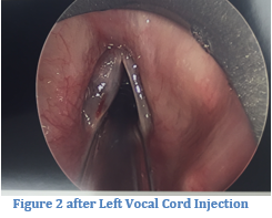 vocal-cord-injection2