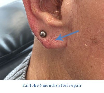 split-earlobe-2