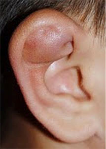 AURICULAR HEMATOMA / CAULIFLOWER EAR REPAIR