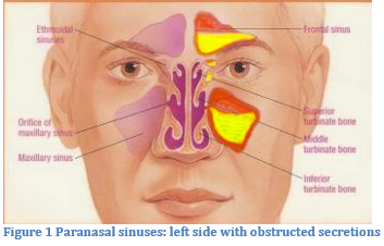 Functional Endoscopic Sinus Surgery Chicago Il