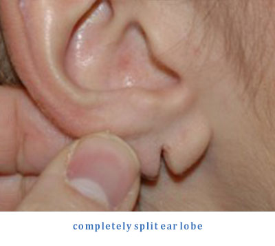 Repair of Torn Ear Lobe