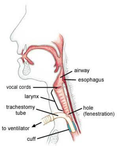 tracheostomy tube parts
